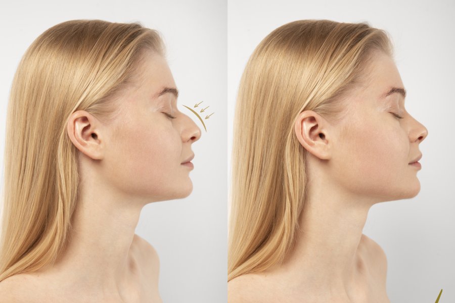 Burun Estetiği Ameliyatı